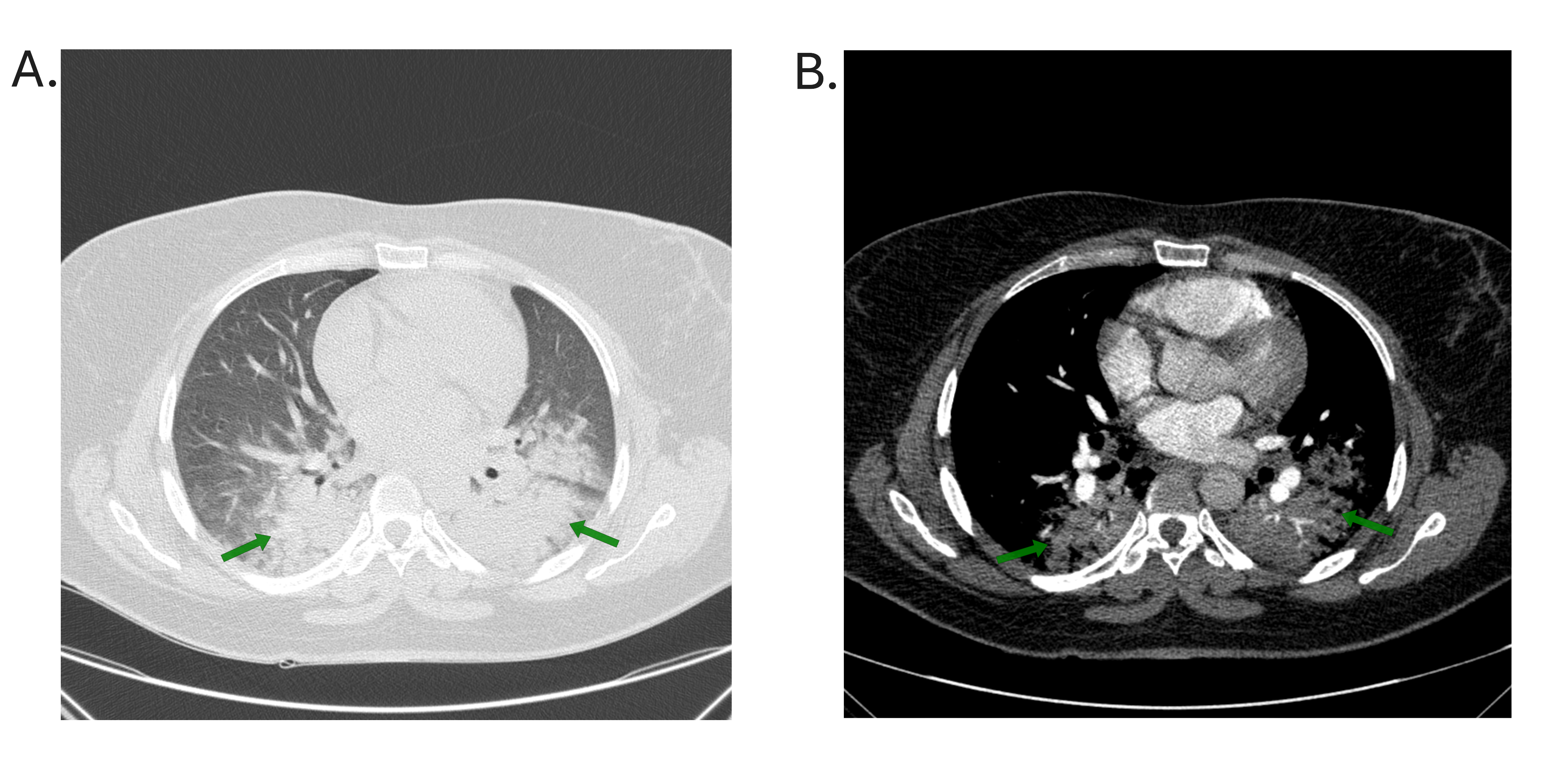 Figure 4. Chest CT axial section A. lung window HRCT, B. mediastinal window with IV contrast. Bilateral consolidation more in dependent parts of lungs “green arrow”, there was no pulmonary embolism, no mass. Differential diagnosis for this imaging feature are pulmonary edema and aspiration pneumonia.