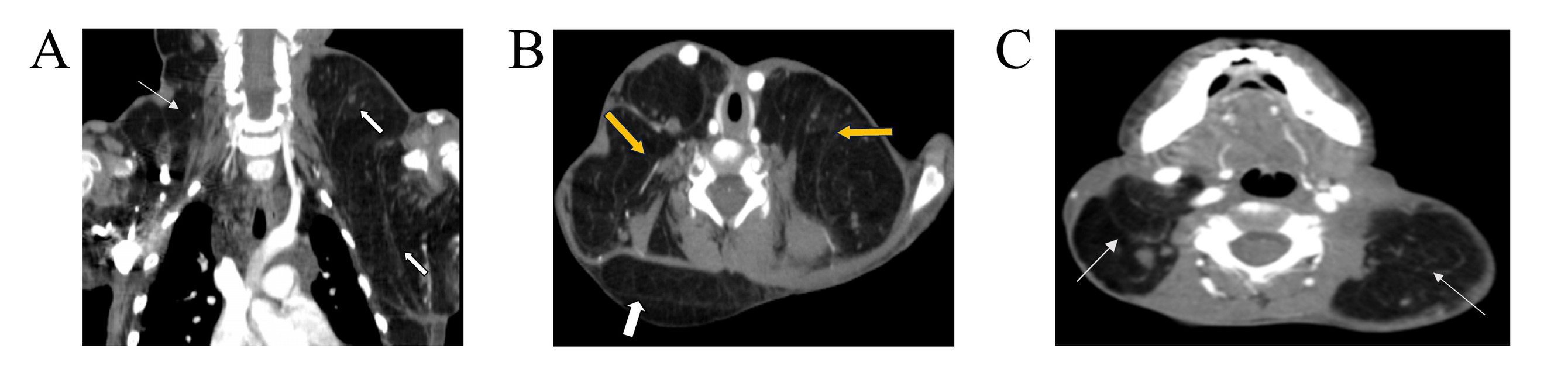 Figure 2. Contrast-enhanced computed tomography scan of the neck & upper chest A) sagittal reconstructed image showed non-enhancing hypodense (fat density) mass in the left axilla extending to the left supraclavicular region (solid white arrows), hypodense mass in the right side of the neck (thin white arrow).  B and C) axial images showed bilateral hypodense neck masses in supraclavicular regions (yellow arrows), posterior triangles bilaterally (thin white arrows) & right posterior neck (solid white arrow).