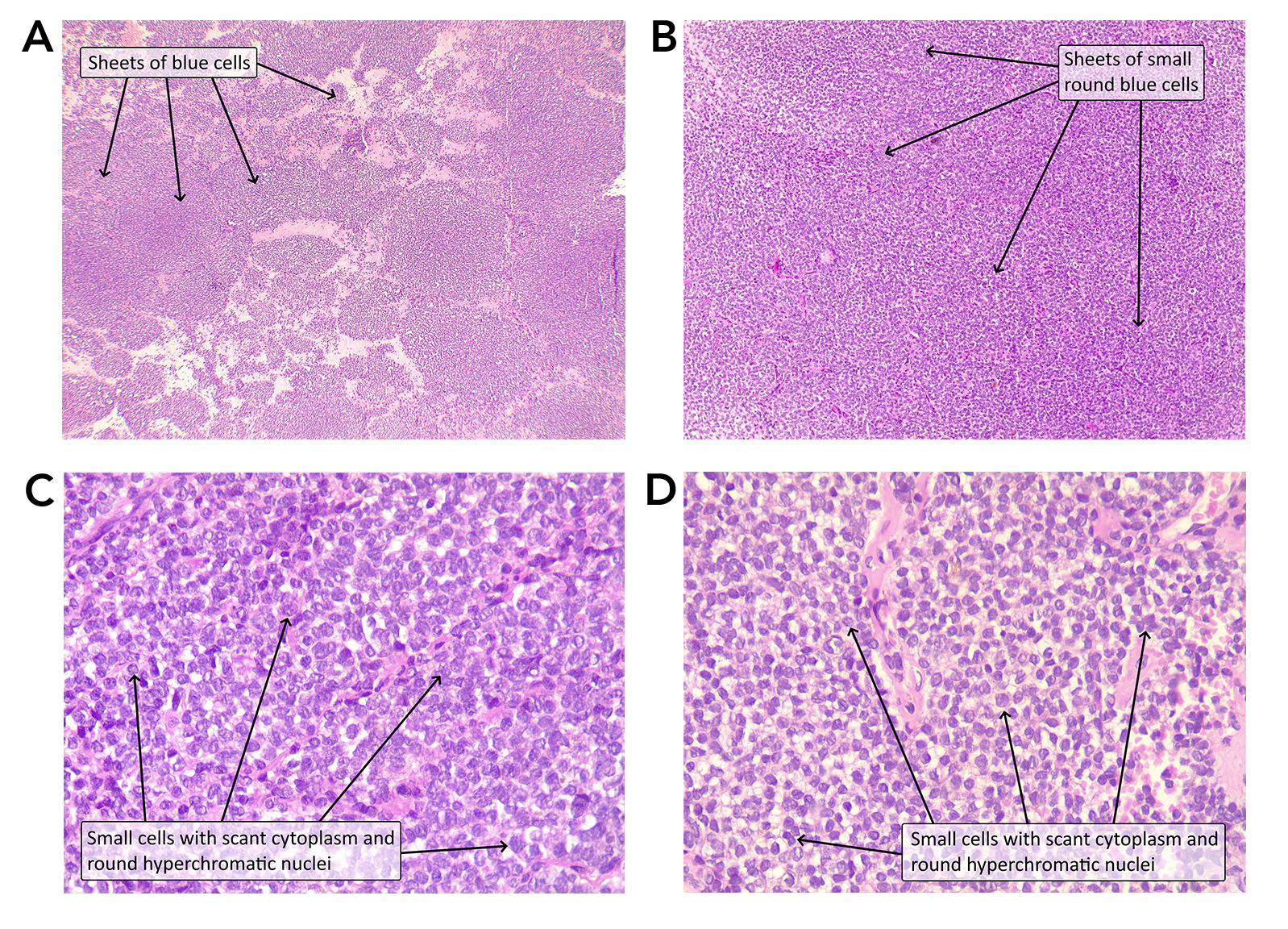 Figure 2) A-B) The tumor is composed of sheets of small, round, blue cells. C-D) The tumor cells have scant lightly eosinophilic to clear cytoplasm with round, hyperchromatic nuclei. [Hematoxylin and eosin; original magnification x 40 (A), x 100 (B), x 400 (C and D)].