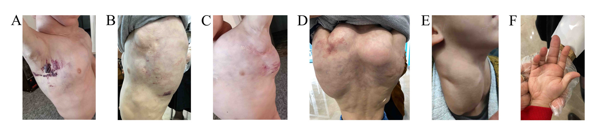 Figure 1. A) Right mid-axillary region with multiple red to purplish raised vesicular lesions approximately 10 cm in width.  B-C) The left axillary region, with similar but less raised lesions. D) The left upper back with small, raised vesicular, pink to skin-colored lesions were present, diffuse swelling in the entire middle and upper back, with a pronounced rounded bulge in the right upper back. E) Swelling of the lateral neck on the right side. F) swelling in the right middle finger.