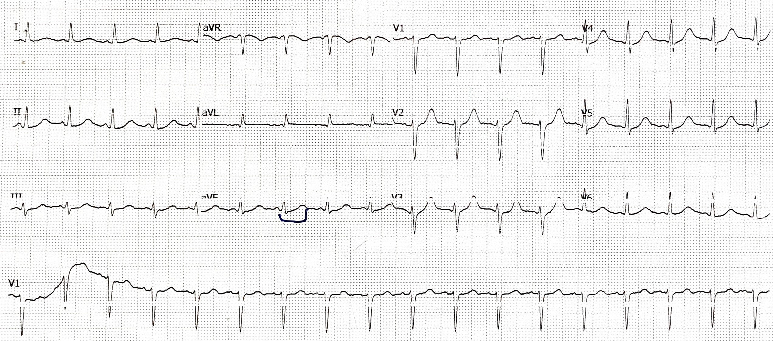 Figure 3. The 12-lead electrocardiogram showed sinus tachycardia with a heart rate of 105 beats per minute and a regular rhythm with visible P waves preceding each QRS complex. The PR interval was within normal limits, and the QRS complexes were narrow with normal morphology and appropriate R-wave progression across the precordial leads. The cardiac axis was normal, and no significant ST-segment elevation or depression was observed. The QT interval measured 380 ms. The automated ECG reported a corrected QT interval of 504 ms using the Bazett formula, which appears prolonged. However, because the heart rate was approximately 105 beats per minute, Bazett correction may overestimate the QT interval at higher heart rates. Recalculation using the Fridericia and Framingham formulas yielded corrected QT intervals of 460 ms and 447 ms, respectively.