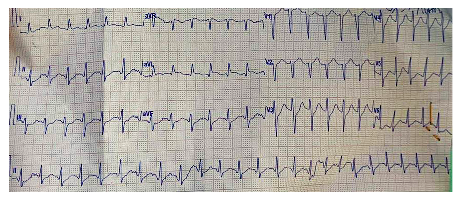 Figure 2. A 12-lead electrocardiogram demonstrated a regular narrow-complex tachycardia with a heart rate of approximately 150 beats per minute, and a QTc of 489ms (calculated using the Fridericia formula). P waves were not clearly discernible, making the precise atrial origin uncertain. The QRS complexes were narrow with normal morphology, and the cardiac axis appeared normal with preserved R-wave progression across the precordial leads. Mild nonspecific ST-segment and T-wave changes were present without definite ST-segment elevation or depression. Overall, the findings were consistent with a regular supraventricular tachycardia with nonspecific repolarization changes.