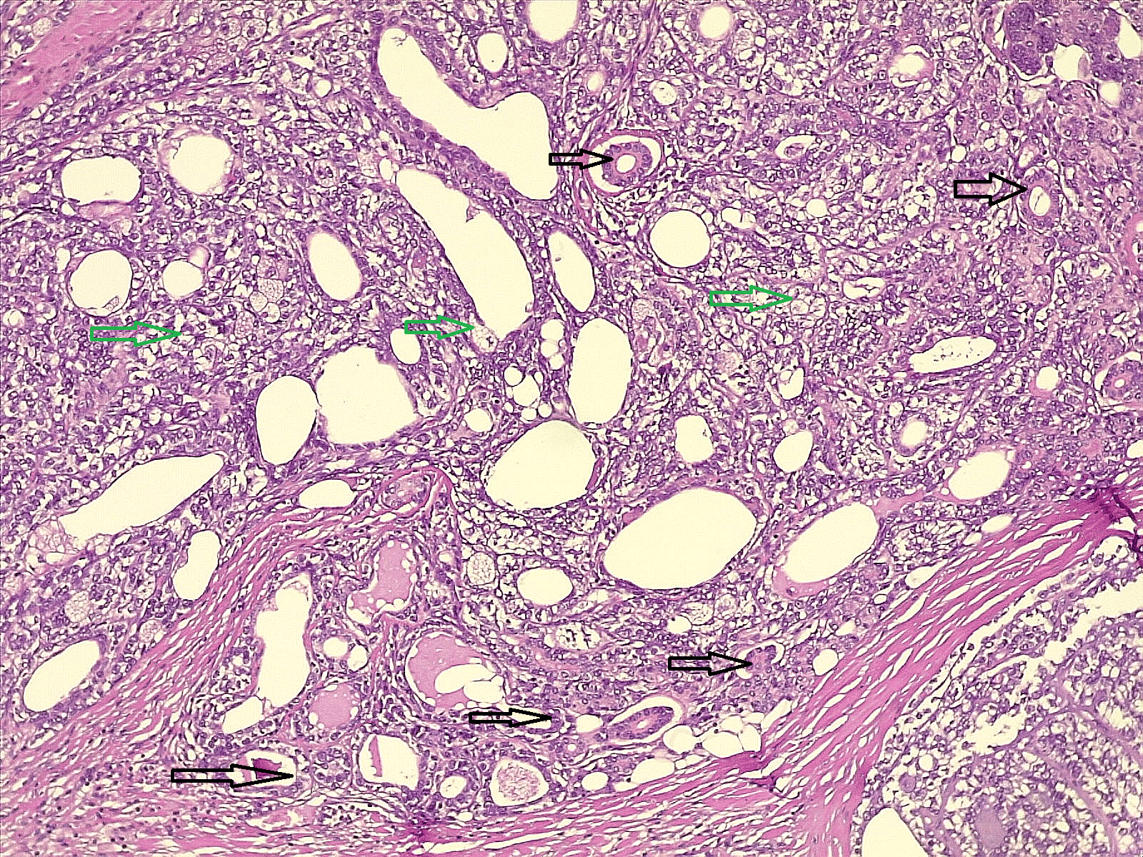 Figure 2. Higher power view showing tumor composed of two populations of cells, some of them arranged as small ducts that lined by epithelial cells (dark arrows) with another populations of cells composed of atypical cells with abundant clear cytoplasm (green arrows). Hematoxylin and Eosin stain. 10X