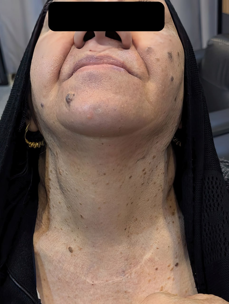 Figure 1. A collar incision in the lower part of the neck was shown during the examination, with no significant palpable findings.