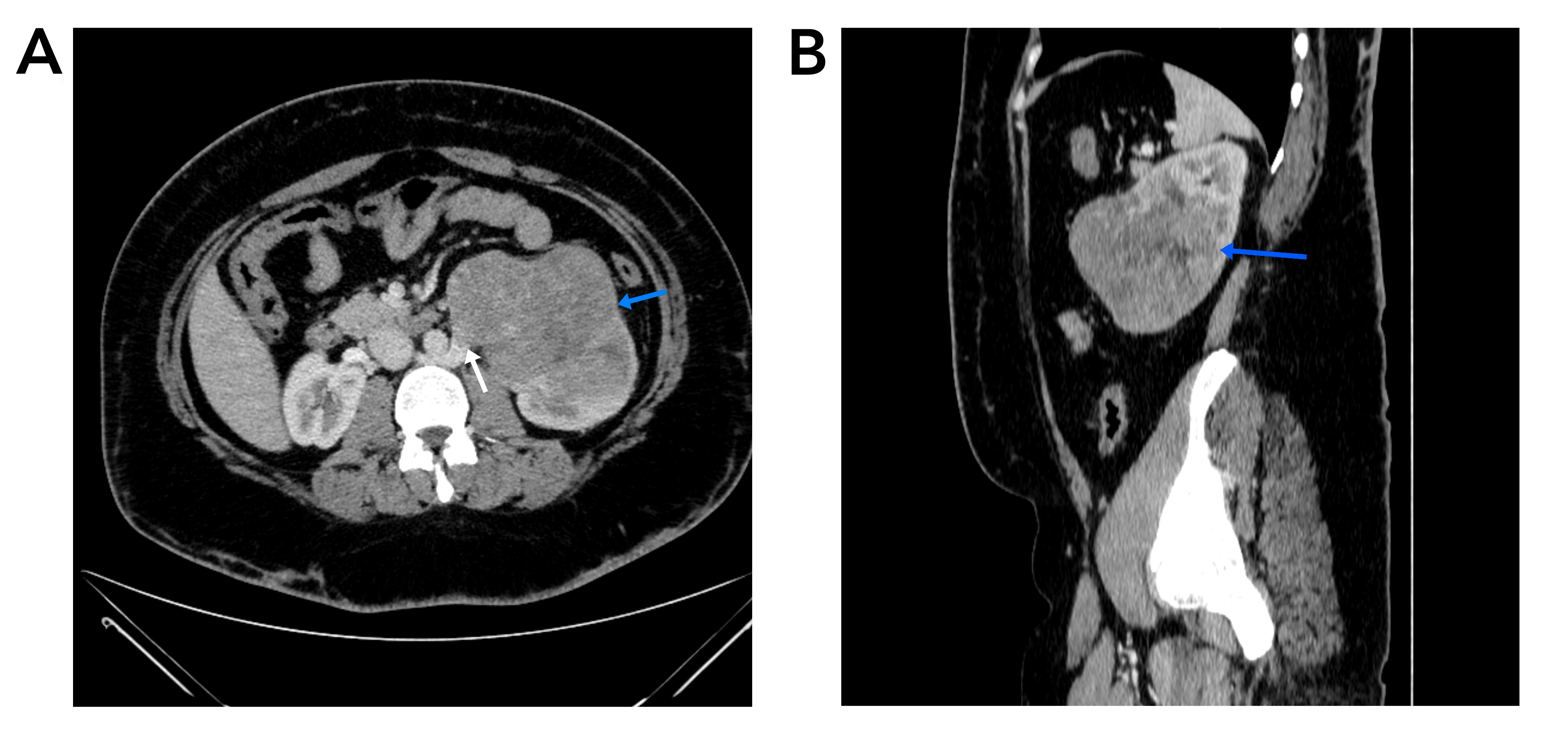 Figure 1) A. Computed tomography (CT) scan with IV contrast (axial section) shows heterogeneously enhanced mass in left kidney (blue arrow) extends to renal vein (white arrow) B. Sagittal section shows mass in midportion and lower pole of left kidney (blue arrow).