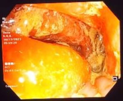 Figure 2. Endoscopic view of volvulus, with congested and dusky mucosa around volvulus area.