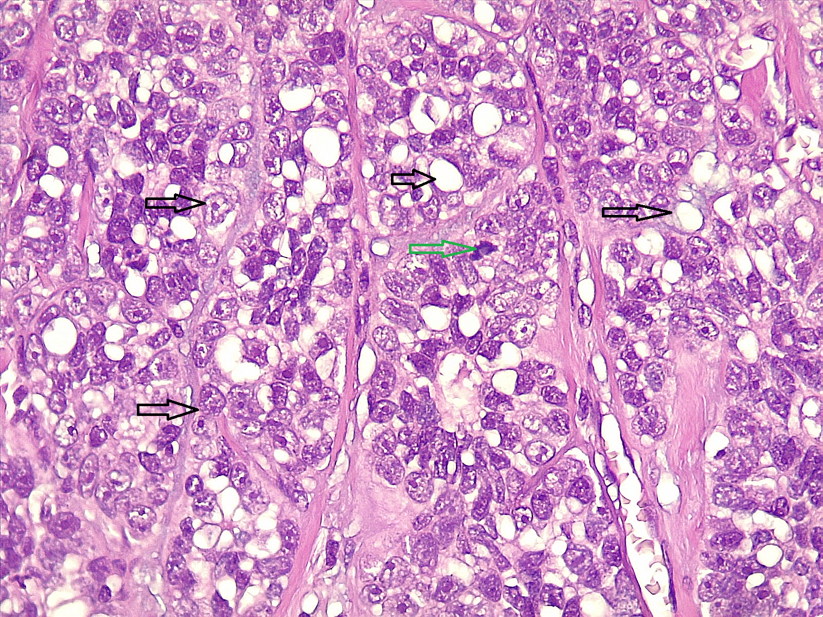 Figure 3. Higher power view showing those atypical cells with clear cytoplasm (dark arrows) with presence of mitotic figure in the middle of the field (green arrow). Hematoxylin and Eosin stain. 40X