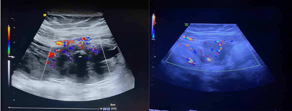 Figure 1. Normal-sized uterus with a 10 mm endometrial lining containing a 20×8 mm endometrial polyp. Both ovaries were normal in size; the right ovary showed a 21 mm dominant follicle and a 14 mm corpus luteum. Adjacent to the left ovary, a 44×30 mm heterogeneous, vascular solid mass with calcifications and indistinct margins was noted, demonstrating a Doppler score of 3–4. The mass showed invasion into the adjacent peritoneum and left rectus abdominis muscle, raising suspicion for a desmoid tumor or other malignant process, with possible involvement of the left ovary
