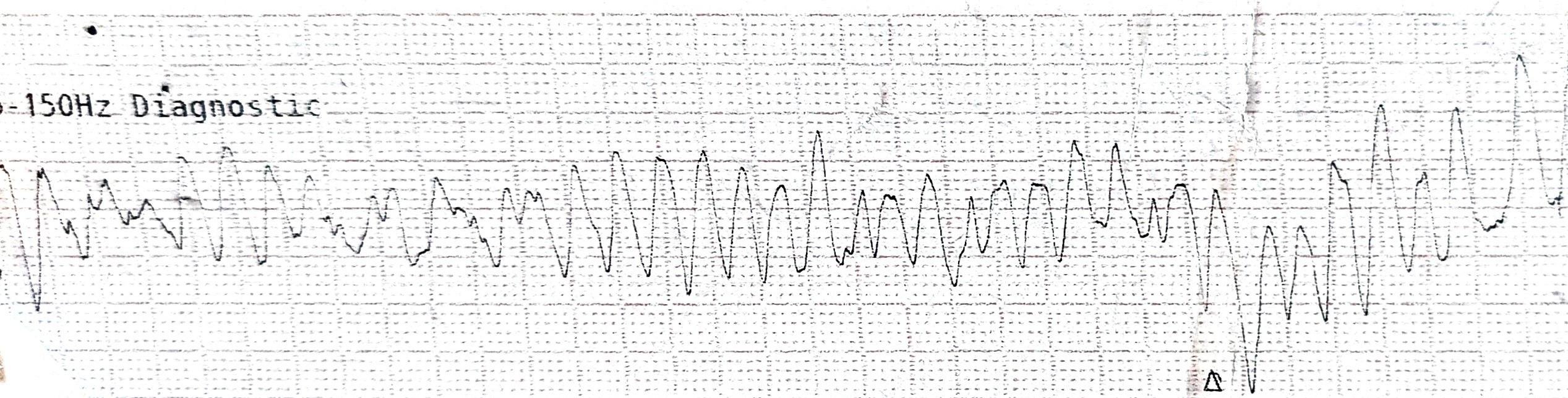 Figure 1. The electrocardiogram showed a rapid polymorphic ventricular tachycardia with a heart rate of approximately 200 beats per minute. The QRS complexes were wide and varied from beat to beat in both amplitude and axis, giving the appearance of a twisting pattern around the isoelectric line. These findings are characteristic of TdP.
