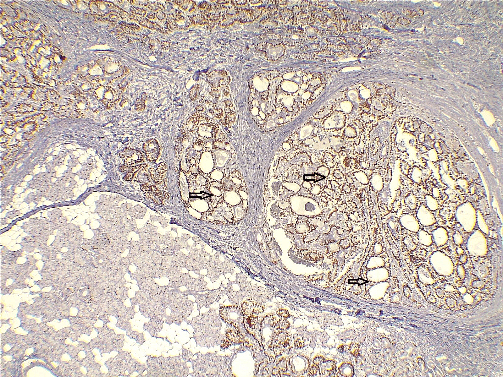 Figure 4. P63 immune stain highlighting the myoepithelial cells (dark arrow). 4x