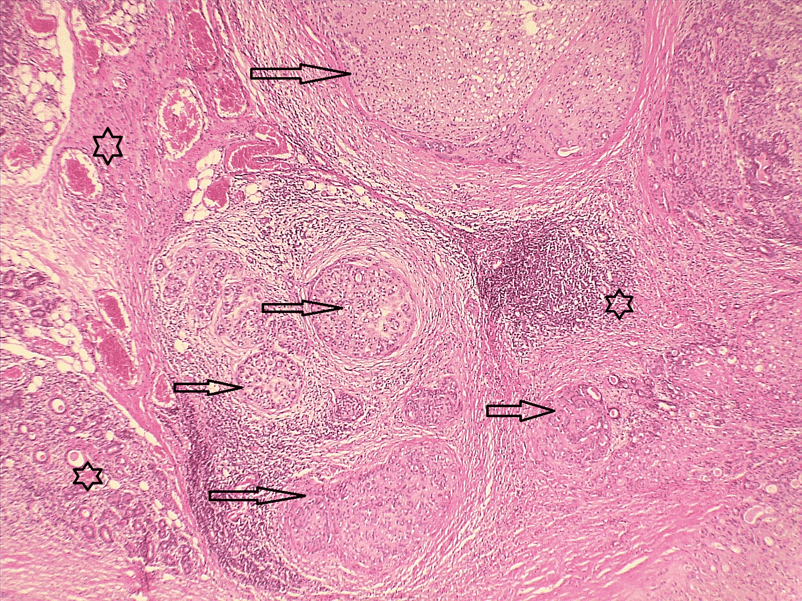 Figure 1. Low power view showing nodules of a lobulated mass (dark arrows) infiltrating into the adjacent salivary gland parenchyma (dark stars). Hematoxylin and Eosin stain. 4x