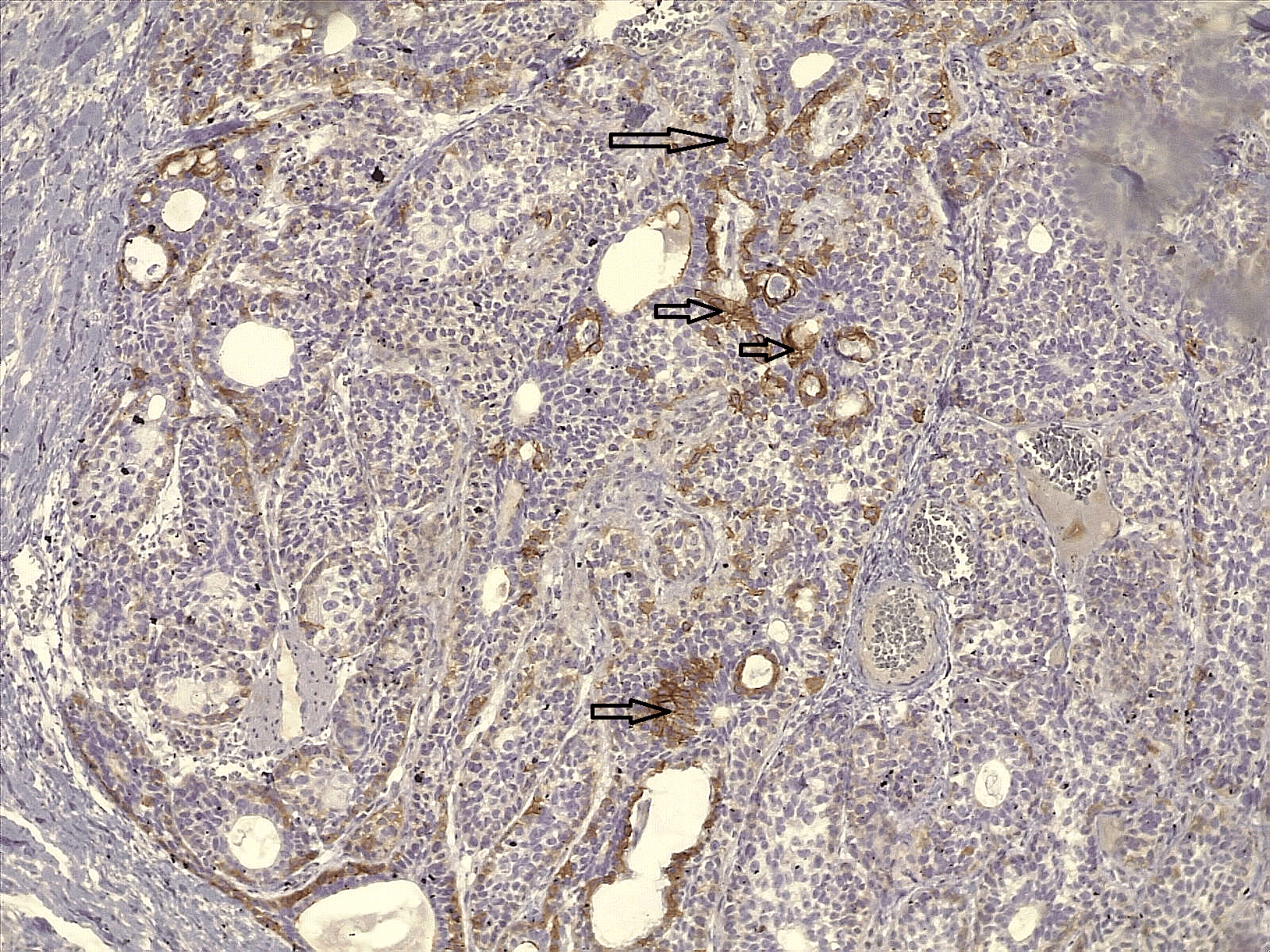 Figure 5. DOG1 immune stain showing apical membranous staining pattern in some of the epithelial cells (dark arrows). 10X